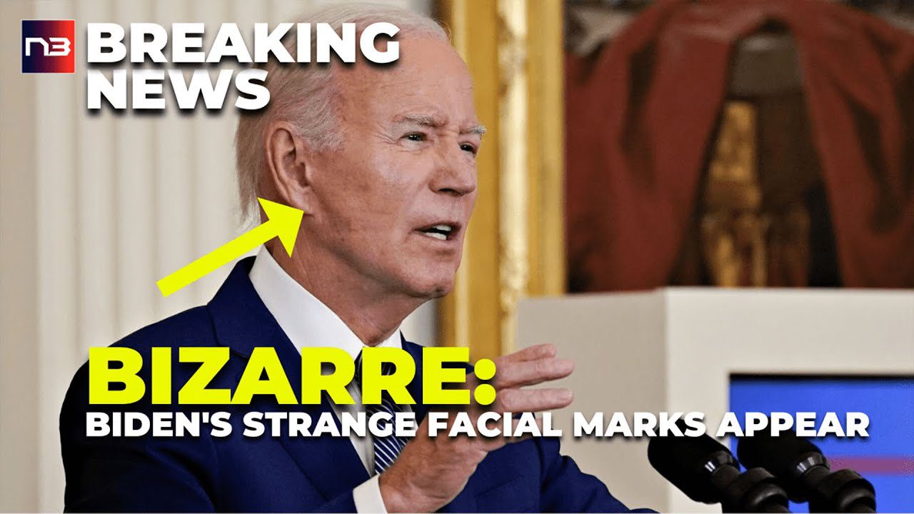 Decoded: Biden's Facial Markings Reveal Hidden Health Battle